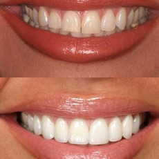 Veneers before and after